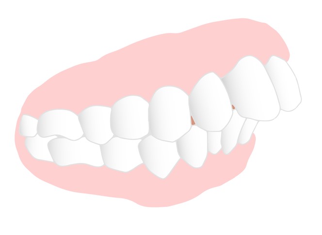 前歯（出っ歯、歯の隙間、傾斜など）