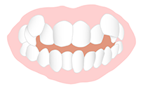 歯並びがでこぼこしている（八重歯・叢生）