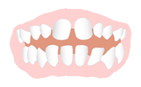 歯と歯の間にすき間がある（すきっ歯）
