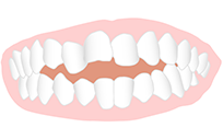 前歯が嚙み合わずすき間ができる（開咬）